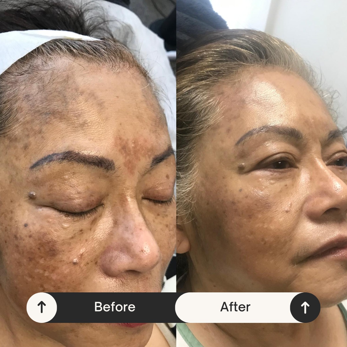 Melasma correction