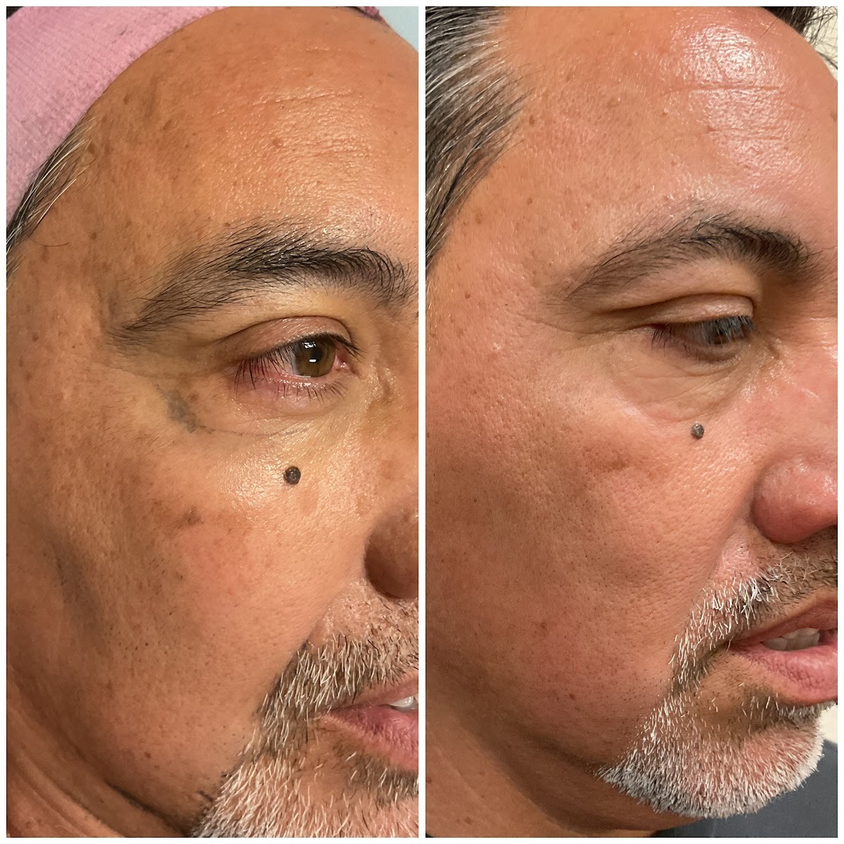 Periorbital rejuvenation