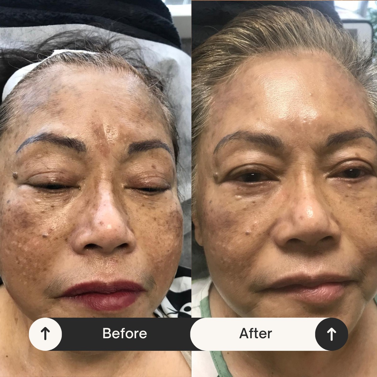 Pigmentation correction