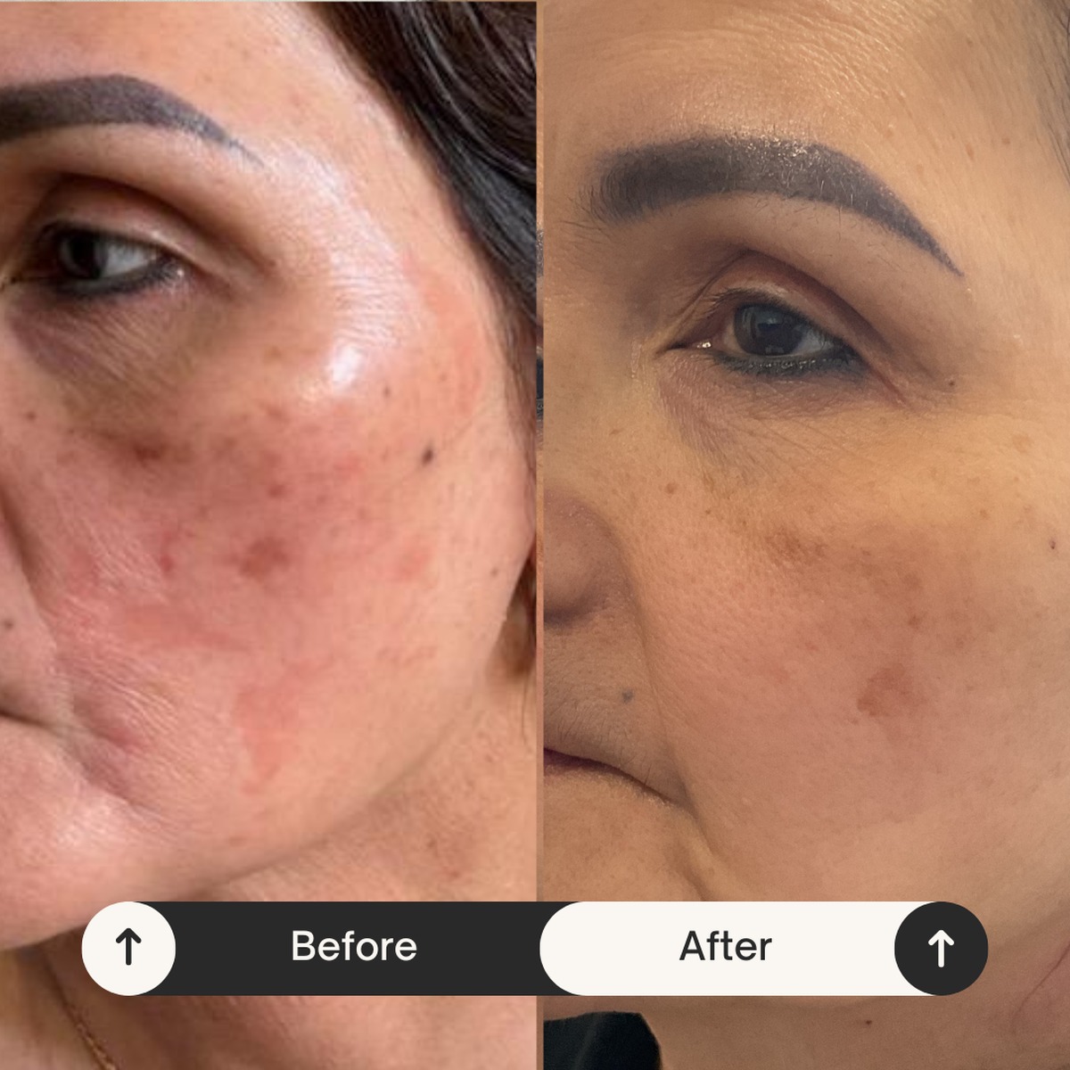 Acne scarring & redness reduction
