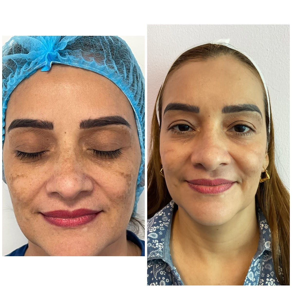 Under-eye bag reduction