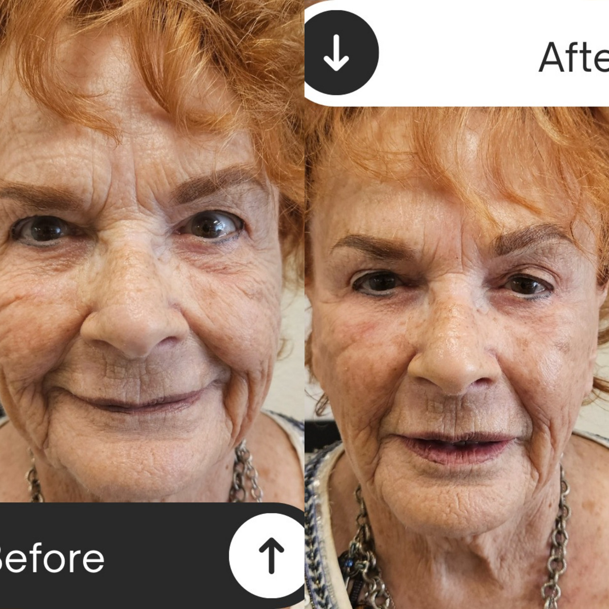 Complete skin rejuvenation