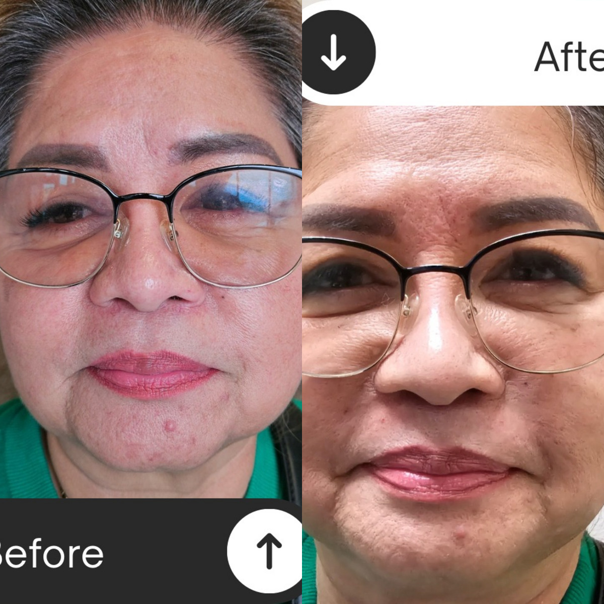 Acne scar treatment