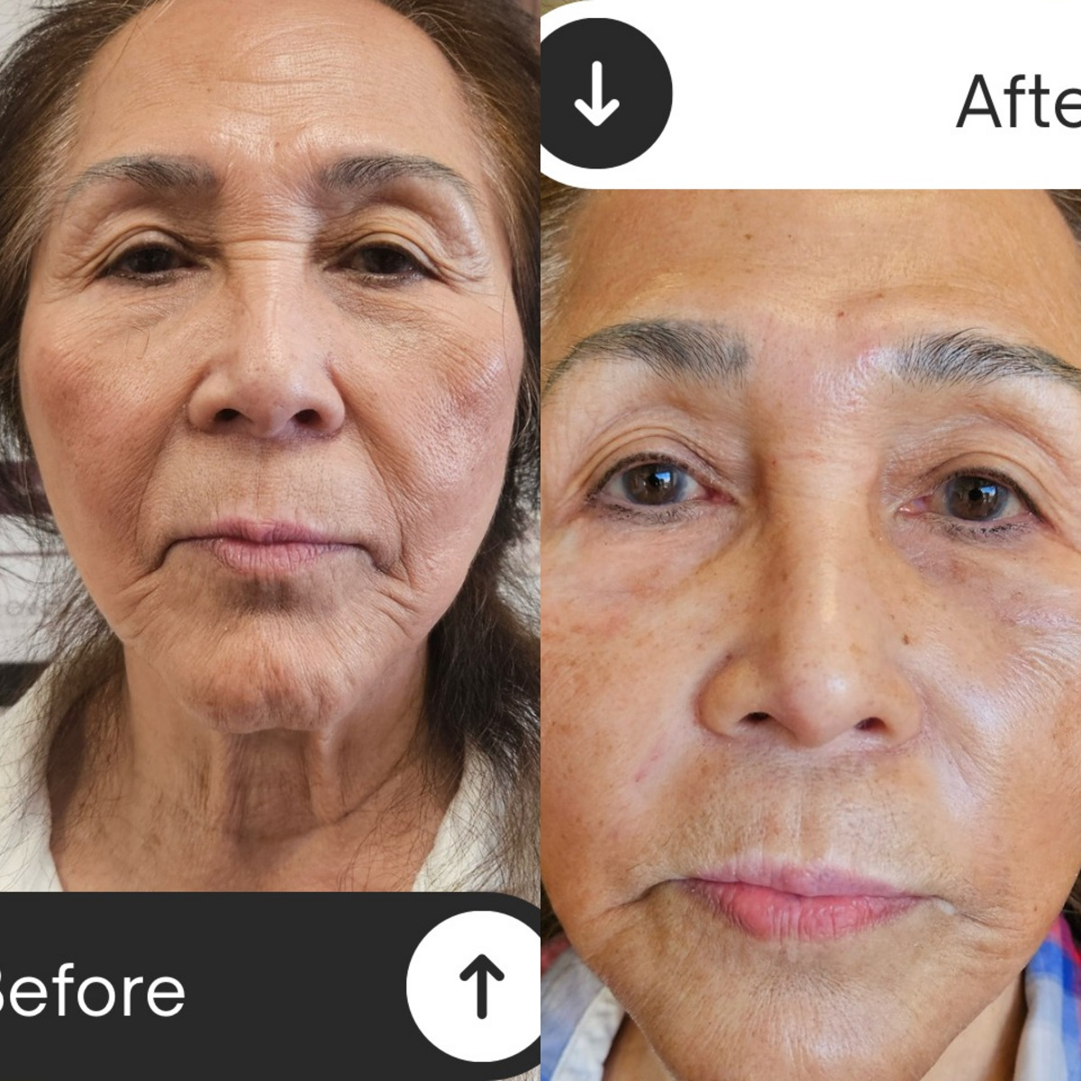 Neck skin tightening